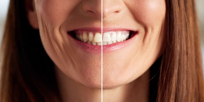 Smile Makeover