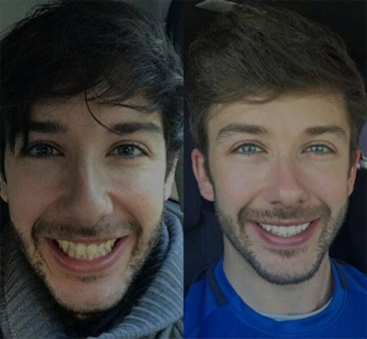 Invisalign®