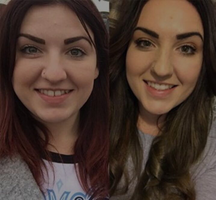 Invisalign®